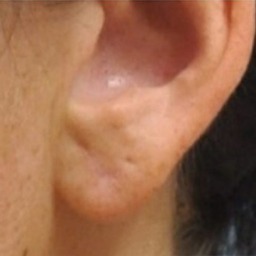 Ear lobe after