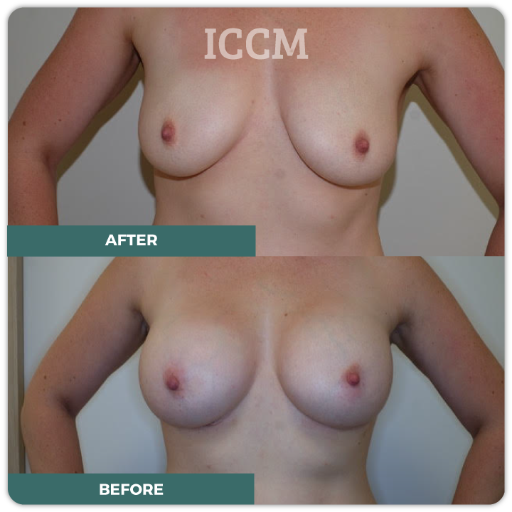 sydney breast augmentation