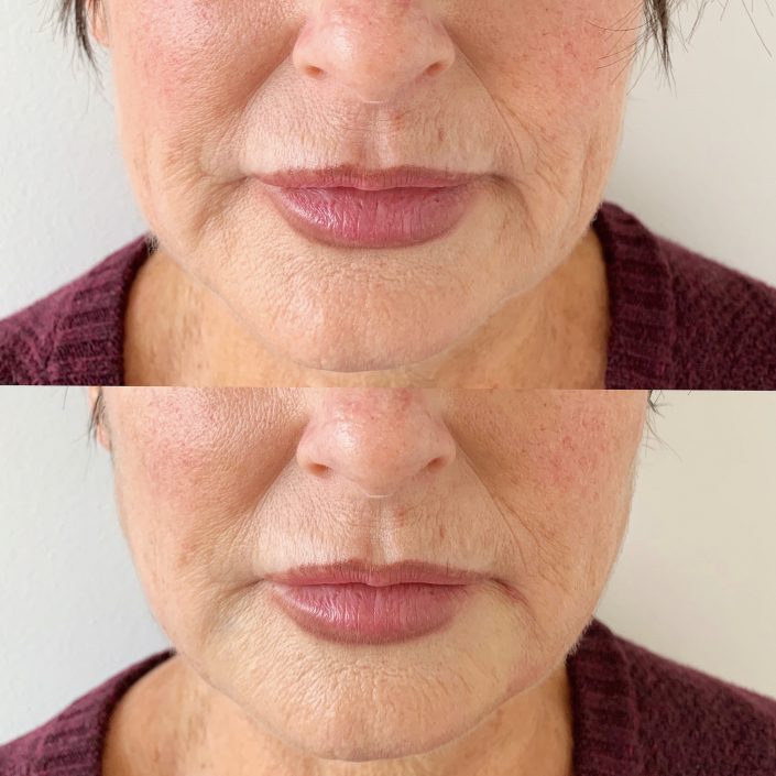 Photo 12-6-19, 4 41 51 pm Thread lift (face & neck lift)
