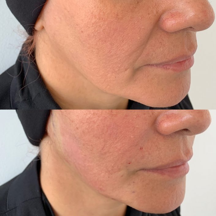 Photo 19-8-19, 3 00 55 pm Thread lift (face & neck lift)