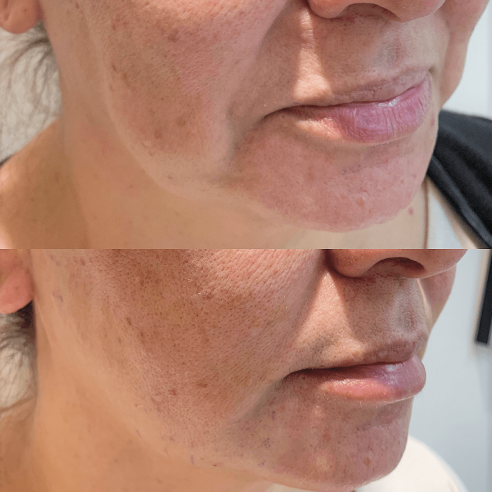 Photo 20-6-19, 9 50 27 pm Thread lift (face & neck lift)