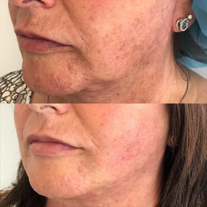 Photo 27-2-19, 12 49 54 pm Thread lift (face & neck lift)