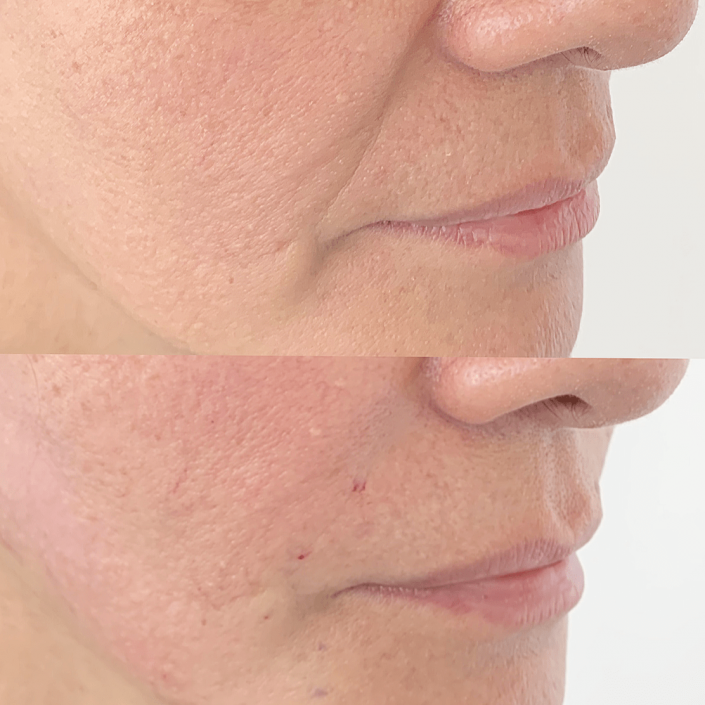 Photo 4-9-19, 4 34 31 pm Thread lift (face & neck lift)