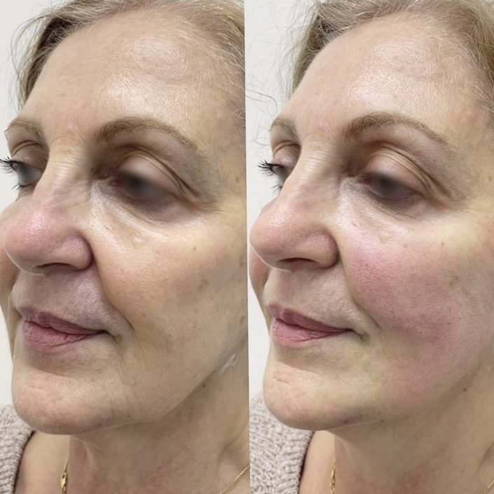 Photo 5-5-19, 8 36 55 pm Thread lift (face & neck lift)