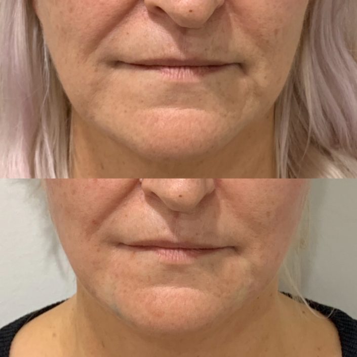 Photo 7-5-19, 5 01 02 pm Thread lift (face & neck lift)