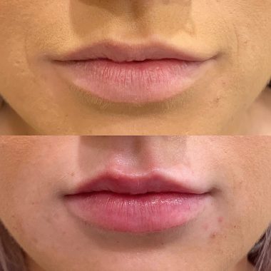 Lip Enhancements