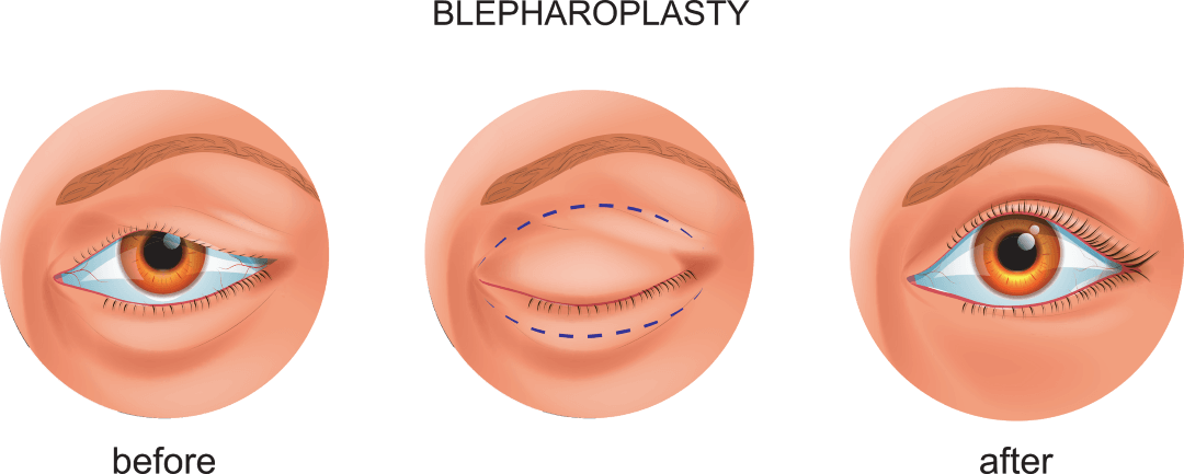 Upper and Lower Blepharoplasty