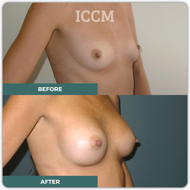 best breast augmentation sydney