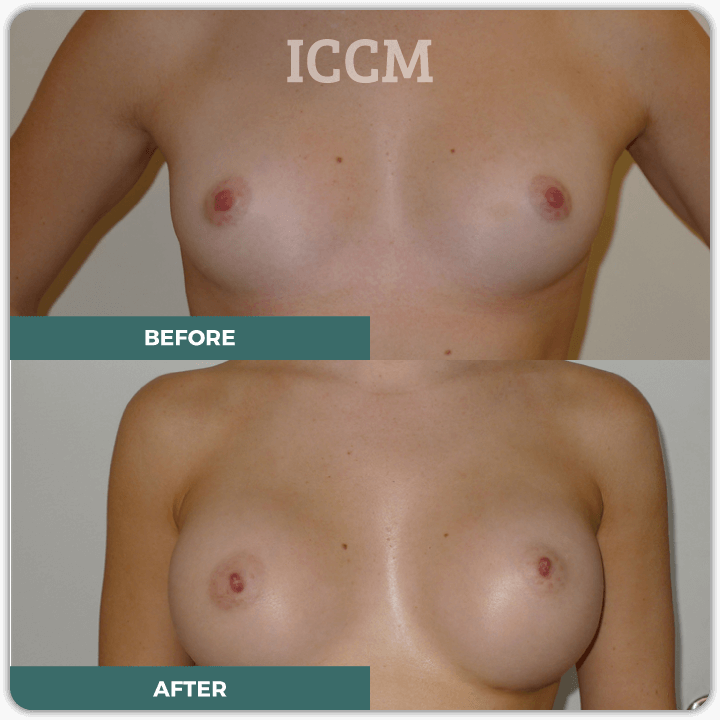 breast enhancement sydney