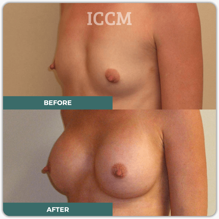 breast augmentation surgery sydney