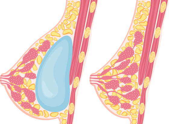 breast augmentation