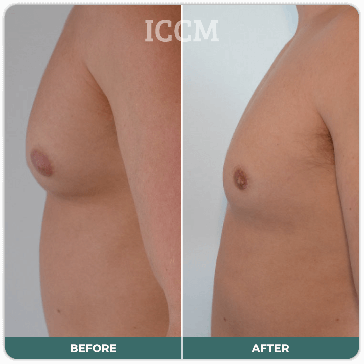 male breast reduction surgery before after
