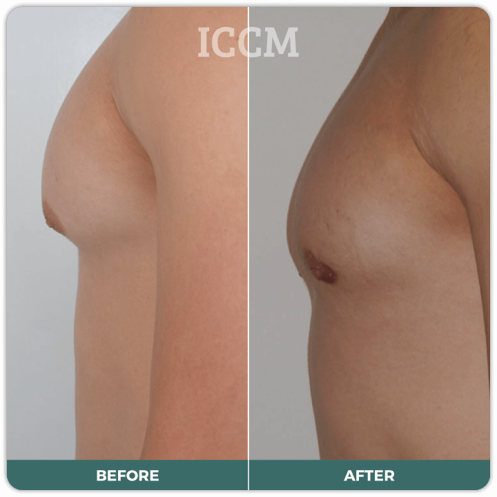 male breast reduction surgery sydney