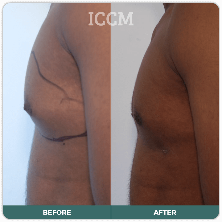 male breast reduction sydney