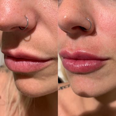 Lip Enhancements
