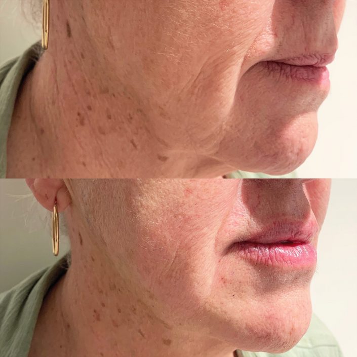 yes thread Thread lift (face & neck lift)