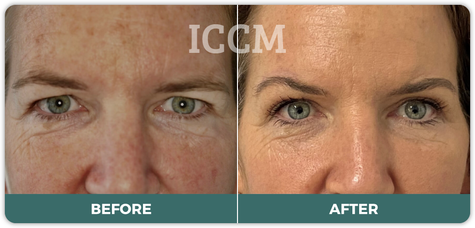 Direct excision brow lift and Upper blepharoplasty