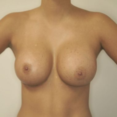 breast augmentation before after