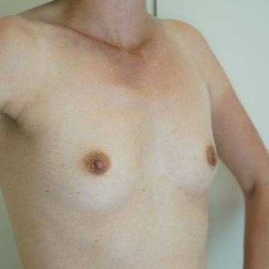 breast augmentation before after