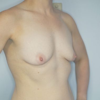 breast augmentation before after