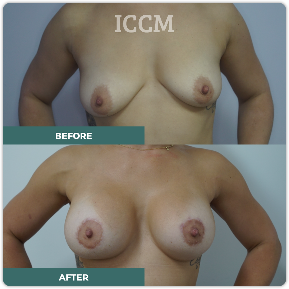 breast lift before after