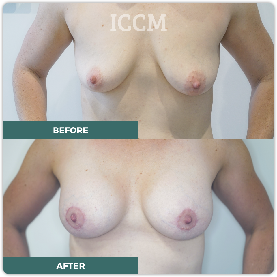 breast lift before after