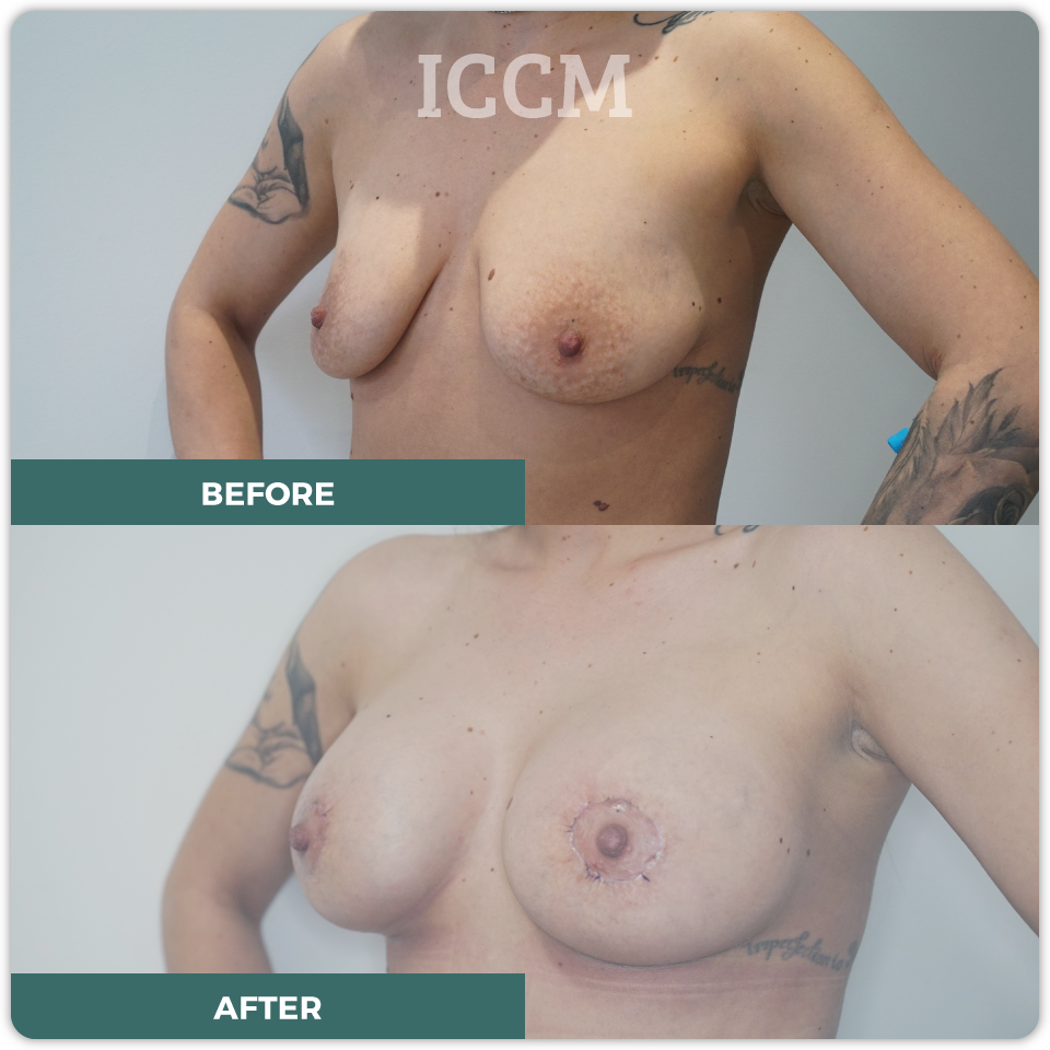 breast lift before after