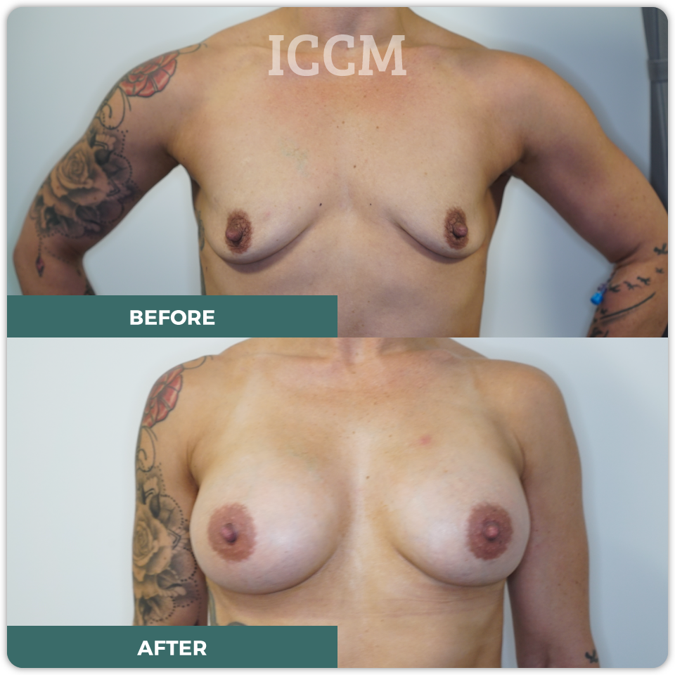 breast lift before after
