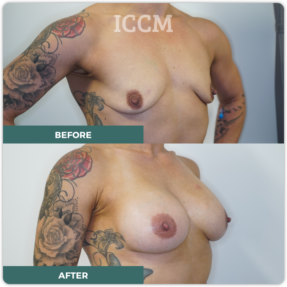 breast lift before after
