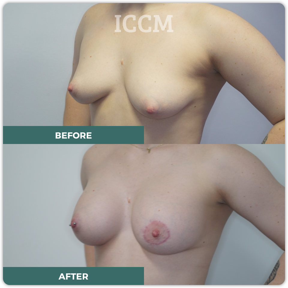 breast lift before after