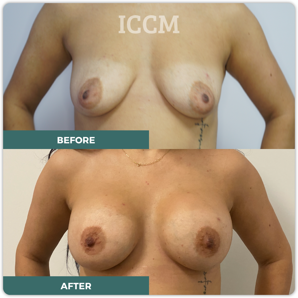 breast lift before after