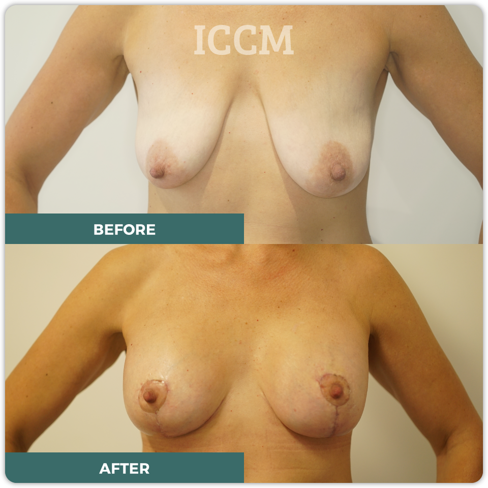 breast lift before after