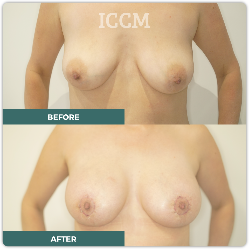 breast lift before after