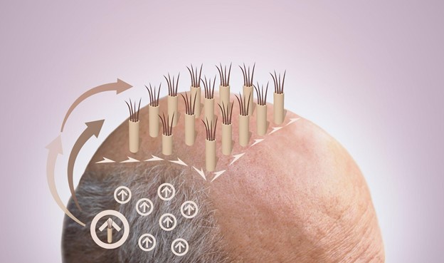 An FUE transplant is a minimally invasive procedure that often leads to permanent results.