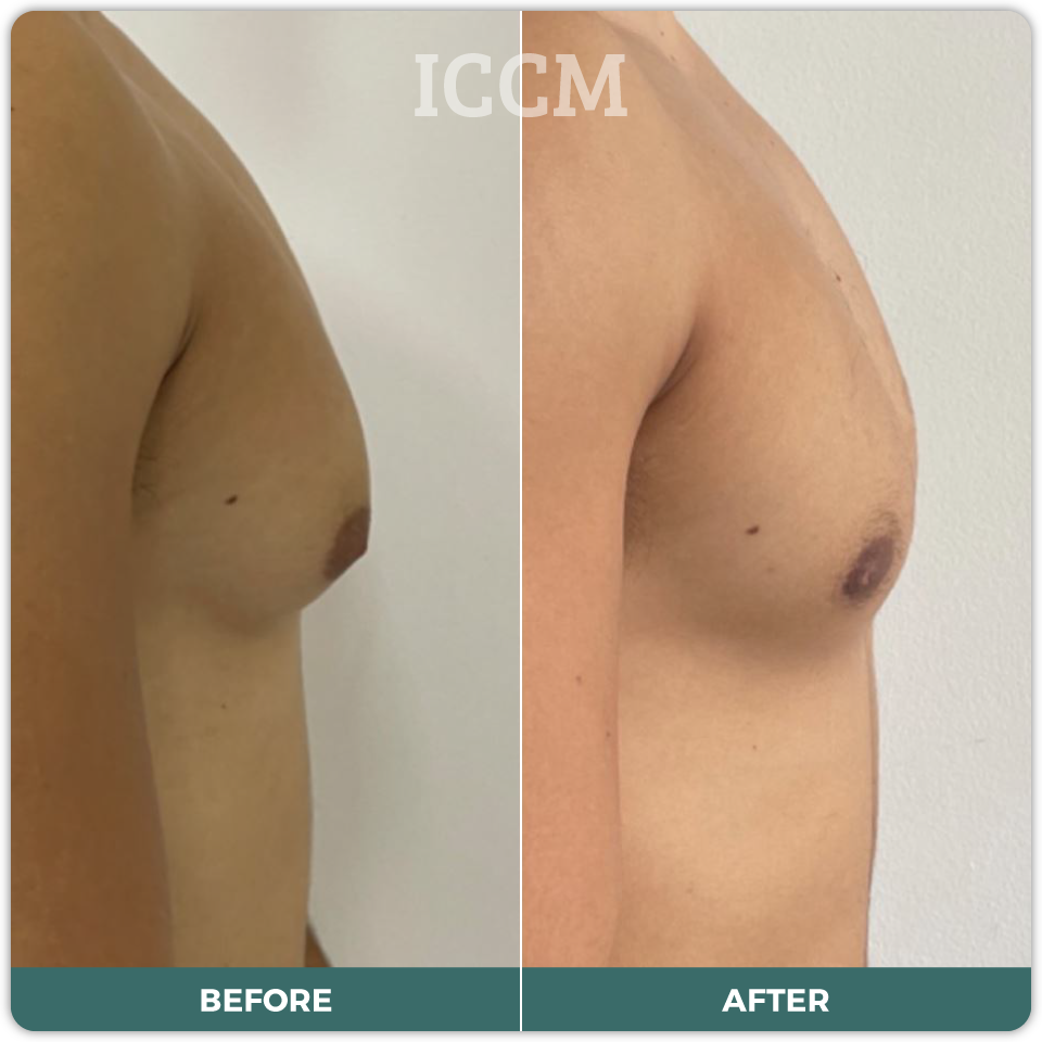 Gynaecomastia Surgery Sydney CBD Campbelltown ICCM