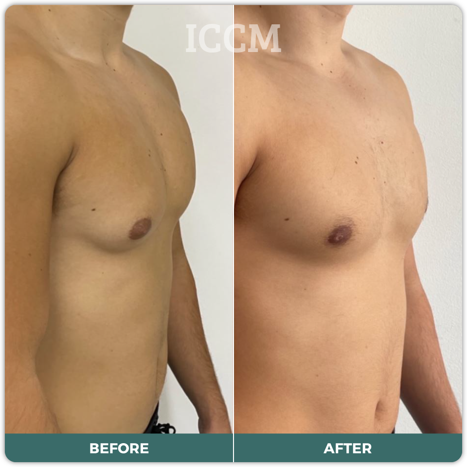 Gynaecomastia Surgery Sydney CBD Campbelltown ICCM