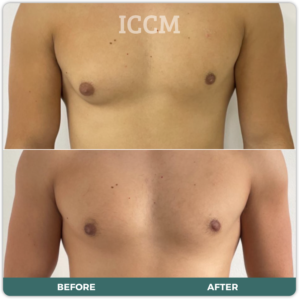 Gynaecomastia Surgery Sydney CBD Campbelltown ICCM