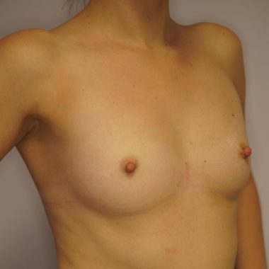 breast augmentation before after