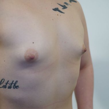 breast augmentation before after