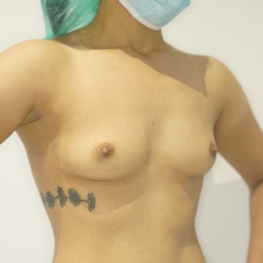 breast augmentation before after