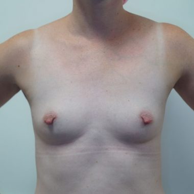 breast augmentation before after