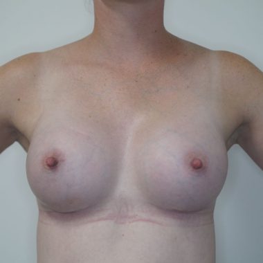 breast augmentation before after