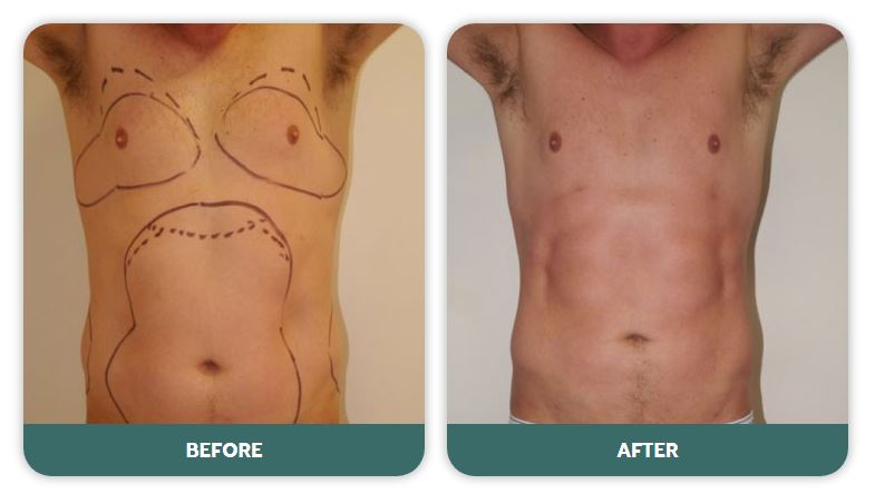 liposculpture liposuction sydney before after