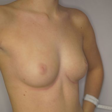 breast augmentation before after