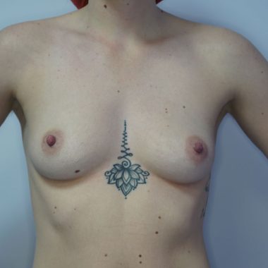 breast augmentation before after