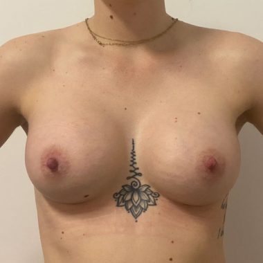 breast augmentation before after