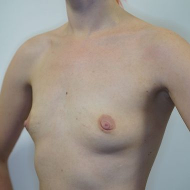 breast augmentation before after