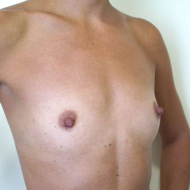breast augmentation before after