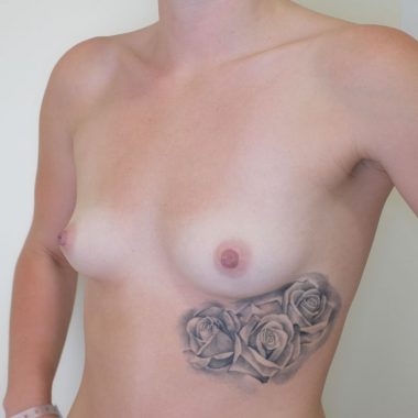 breast augmentation before after