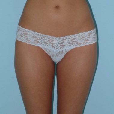 Liposculpture after in Sydney cost